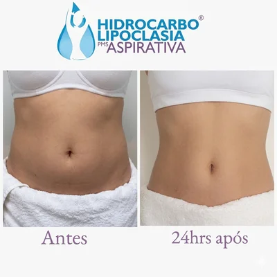 Hidrocarbolipoclasia