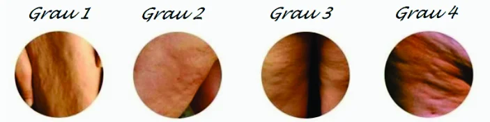 Celulite e Lipedema