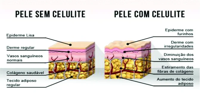 Celulite e Lipedema