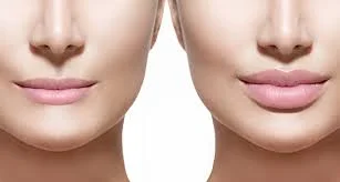 Preenchimento Facial
