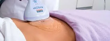 Lipocavitação
