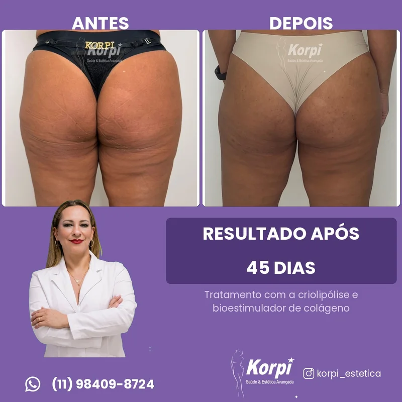 Criolipólise com Bioestimulador