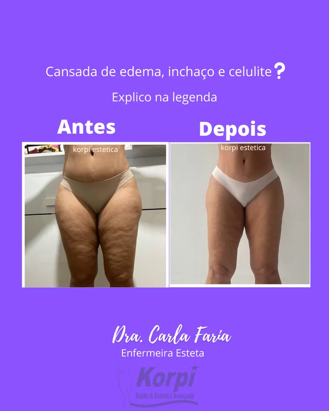 Criolipólise para celulite / lipedema