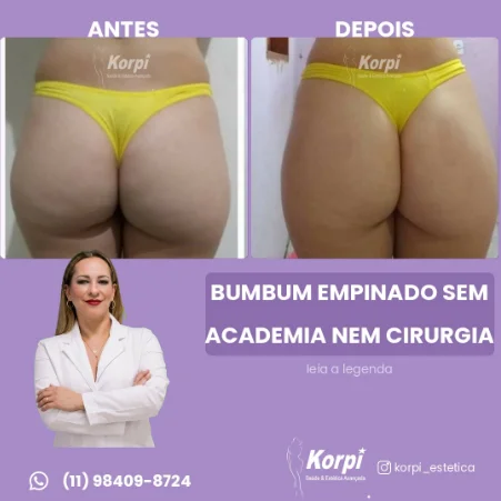 Tratamento combinado ozônioterapia + bioestimulador de colágeno