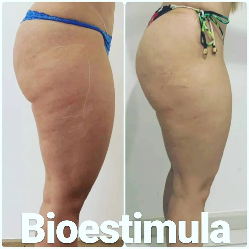 Bioestimulador de Colágeno